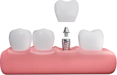 Implante unitário — implante dentário em Santo André