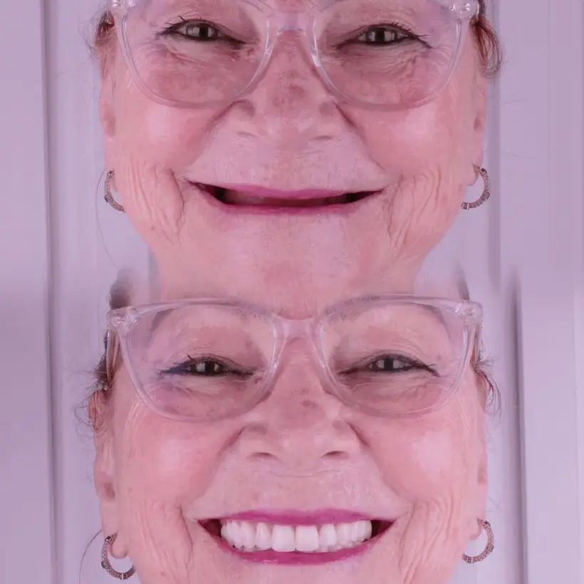 Antes e depois de implante dentário — caso 1, Santo André