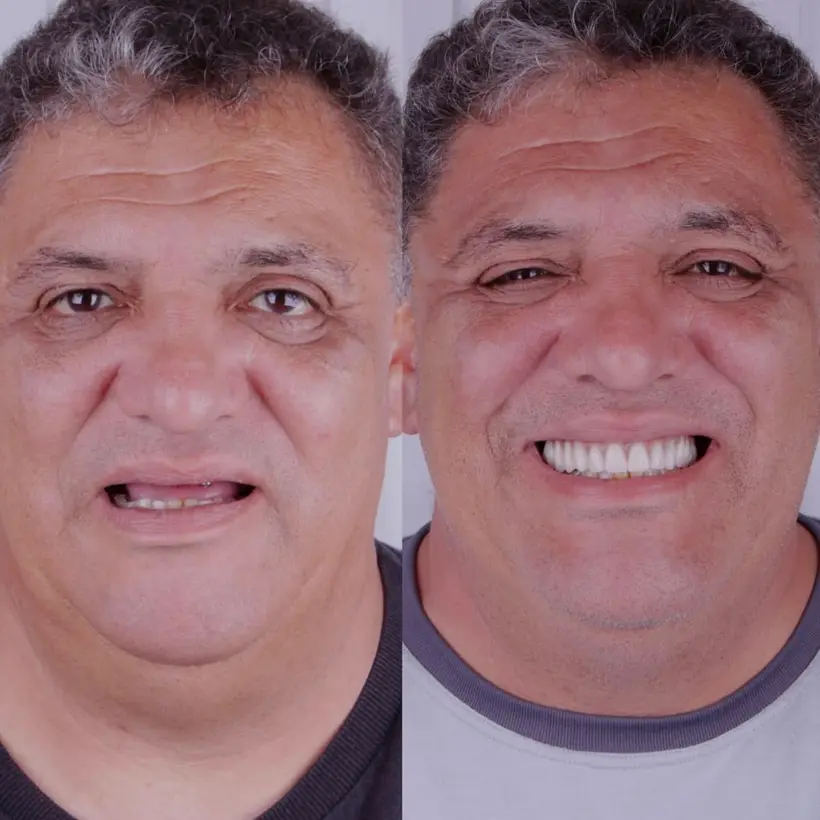 Antes e depois de implante dentário — caso 2, Santo André