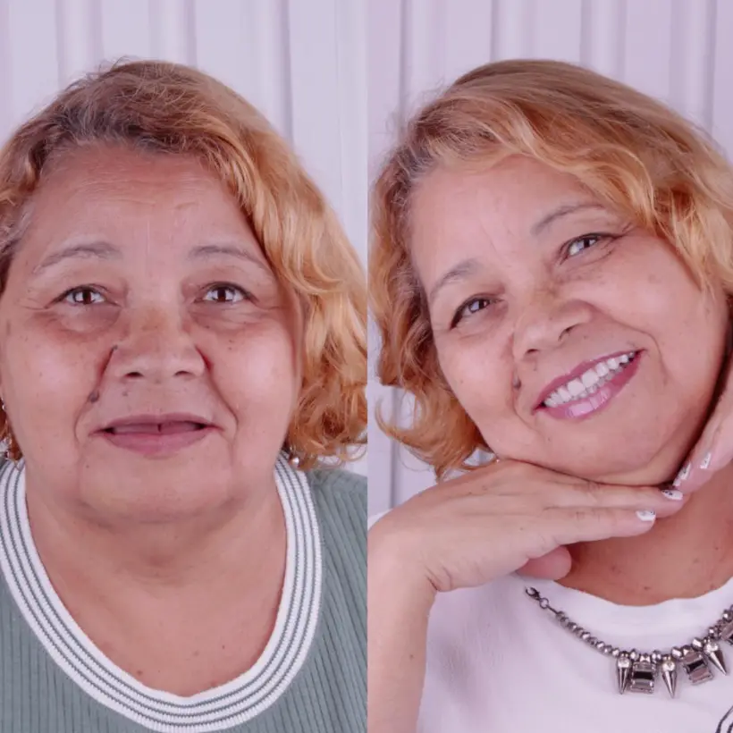 Antes e depois de implante dentário — caso 3, Santo André