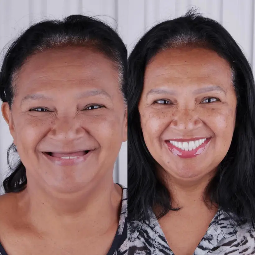 Antes e depois de implante dentário — caso 4, Santo André