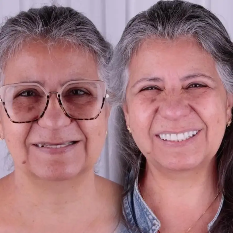Antes e depois de implante dentário — caso 5, Santo André