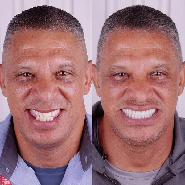 Antes e depois de implante dentário — caso 6, Santo André
