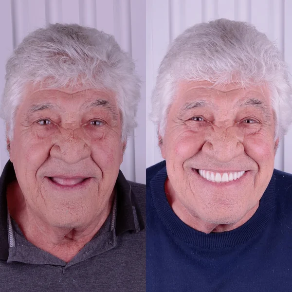 Antes e depois de implante dentário — caso 7, Santo André