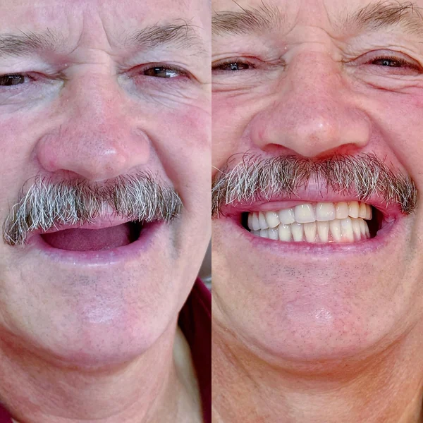 Antes e depois de implante dentário — caso 8, Santo André