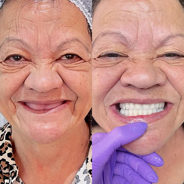 Antes e depois de implante dentário — caso 9, Santo André